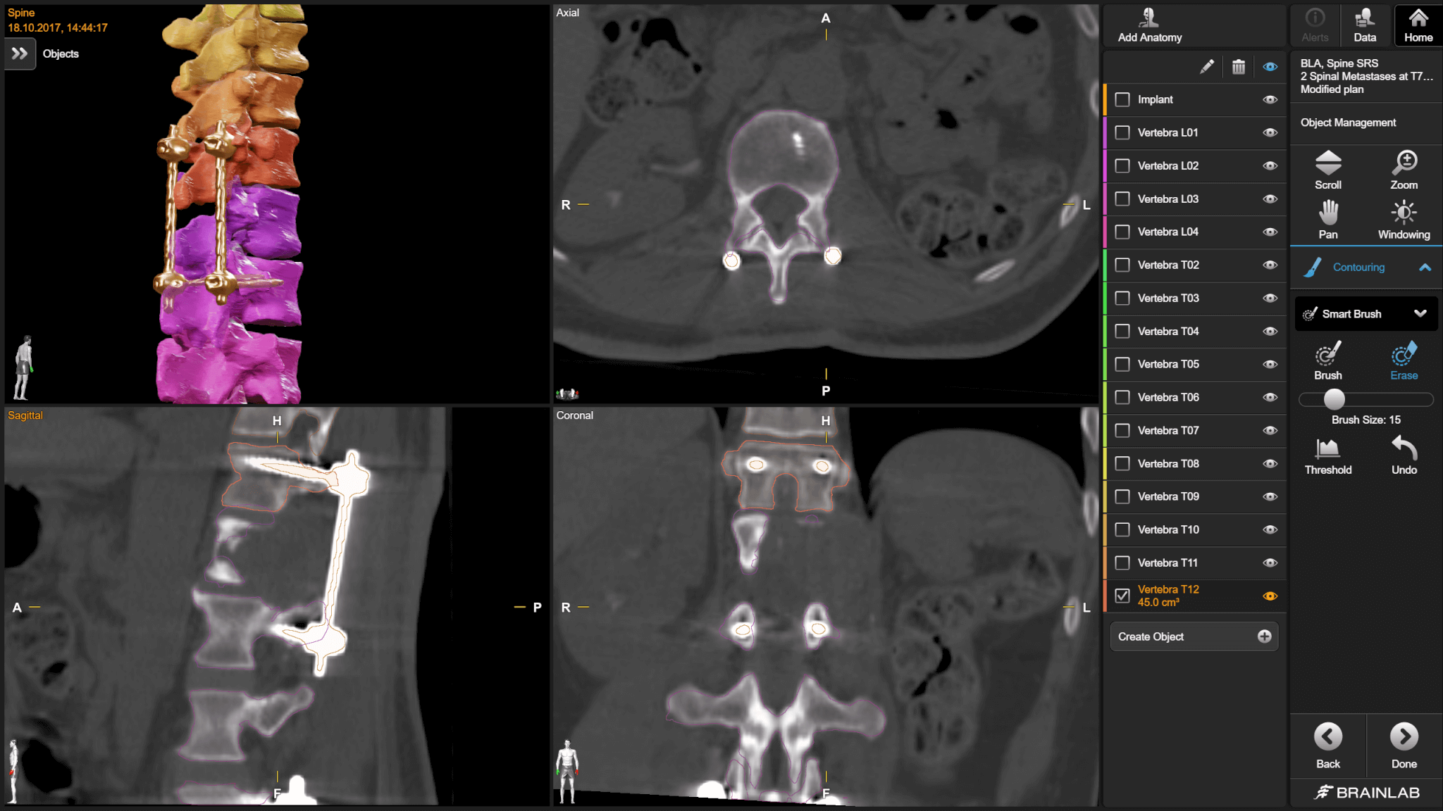 Elements Spine SRS: Spine Metastases Planning | Brainlab